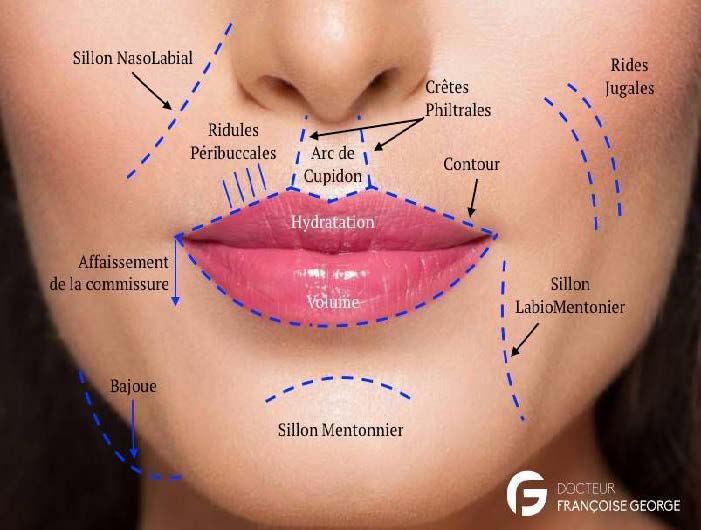 Injections des lèvres - Dr Gridina, Médecin esthétique et laser - Boulogne-Billancourt